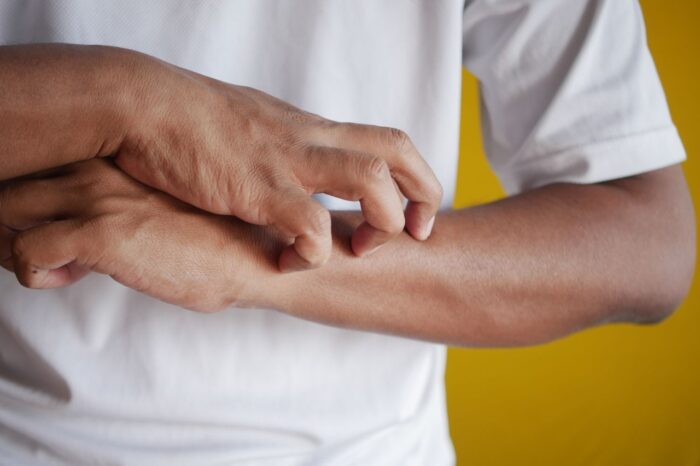 fatty liver itching relief