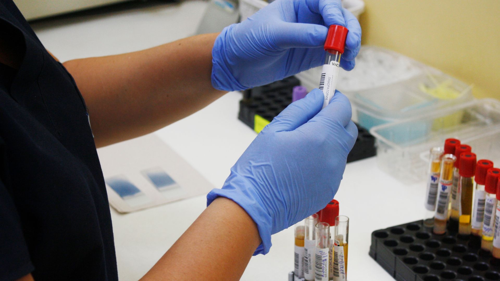 fatty liver blood test results